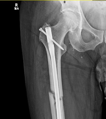 femur-rod-2016-11-03